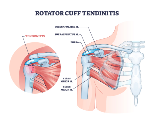 inflamed shoulder tendons