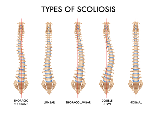 scoliosis chiropractic