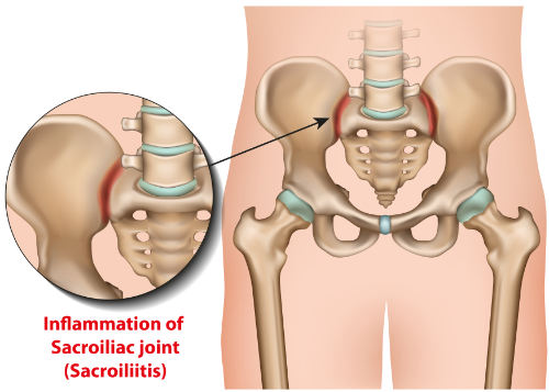 how chiropractic relieves sacroiliac joint pain