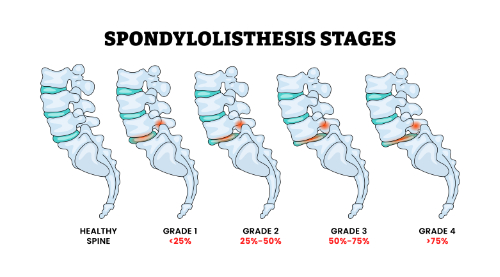 can chiropractic care help patients who suffer from spondylolisthesis