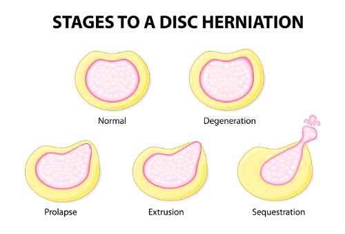 Chiropractic Treatments for Disc Bulge and Herniation