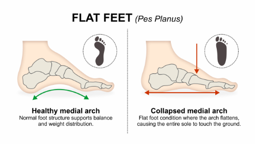 How Flat Feet Can Cause Spinal Subluxations