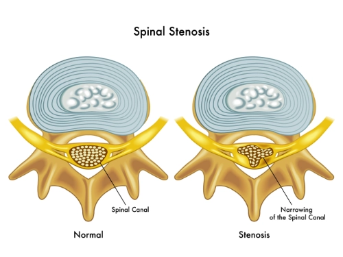 Spinal Stenosis Pain Relief Without Surgery
