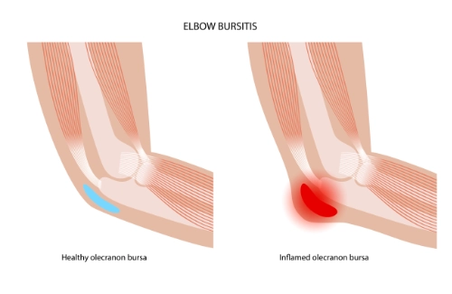 How Chiropractic Care Can Help Elbow Bursitis