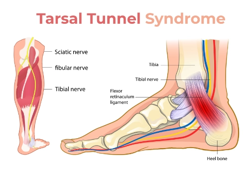 How Chiropractic Care Can Help Tarsal Tunnel Syndrome