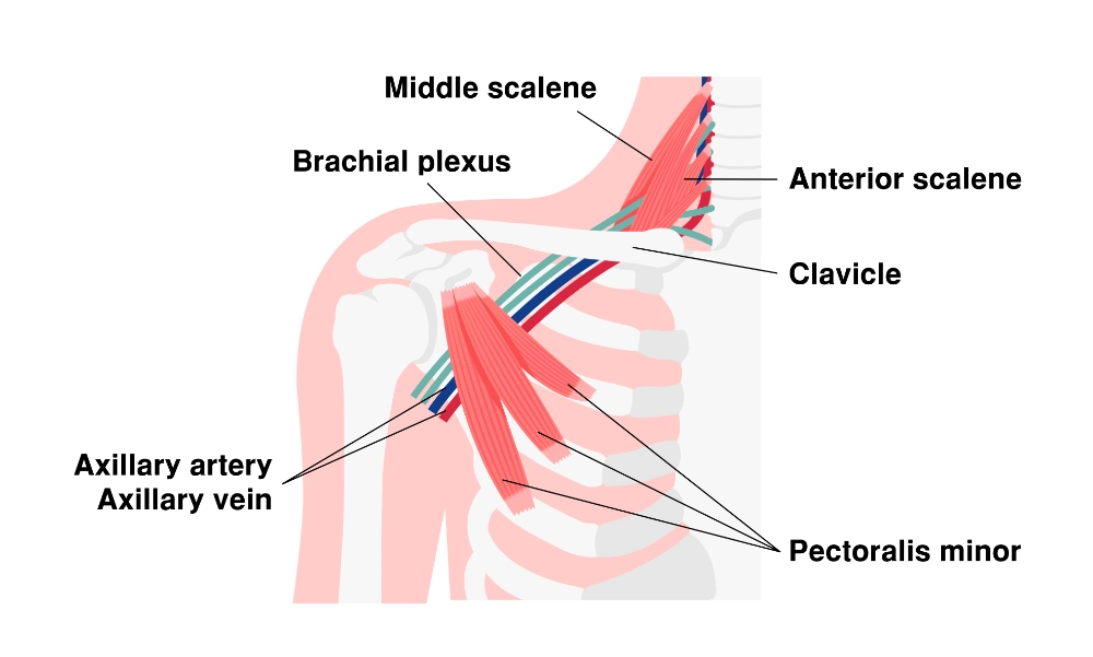 How Chiropractic Care Can Help Thoracic Outlet Syndrome