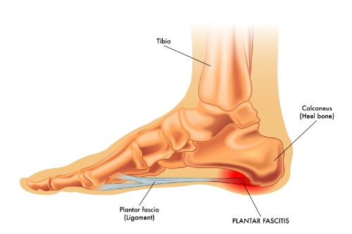 Can Chiropractic Care Help Relieve Plantar Fasciitis?