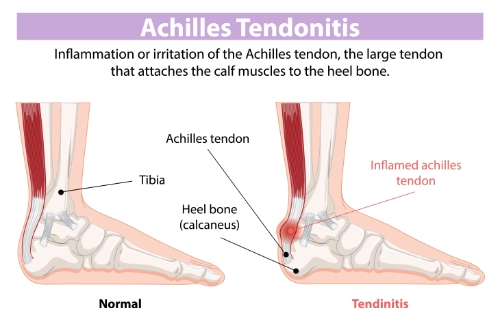 How Chiropractic Care Can Help Achilles Tendinopathy